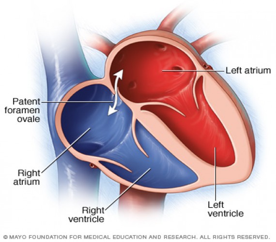 Patent Foramen Ovale