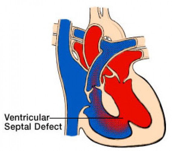 Ventriküler Septal Defekt