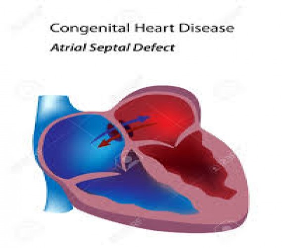 Atriyal Septal Defekt