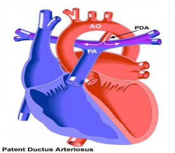 Patent Duktus Arteriyozus