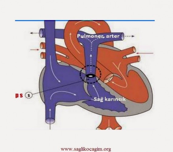 Pulmoner Darlık